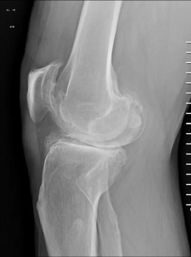 Radiografía lateral de rodilla con cambios degenerativos y osteofitos