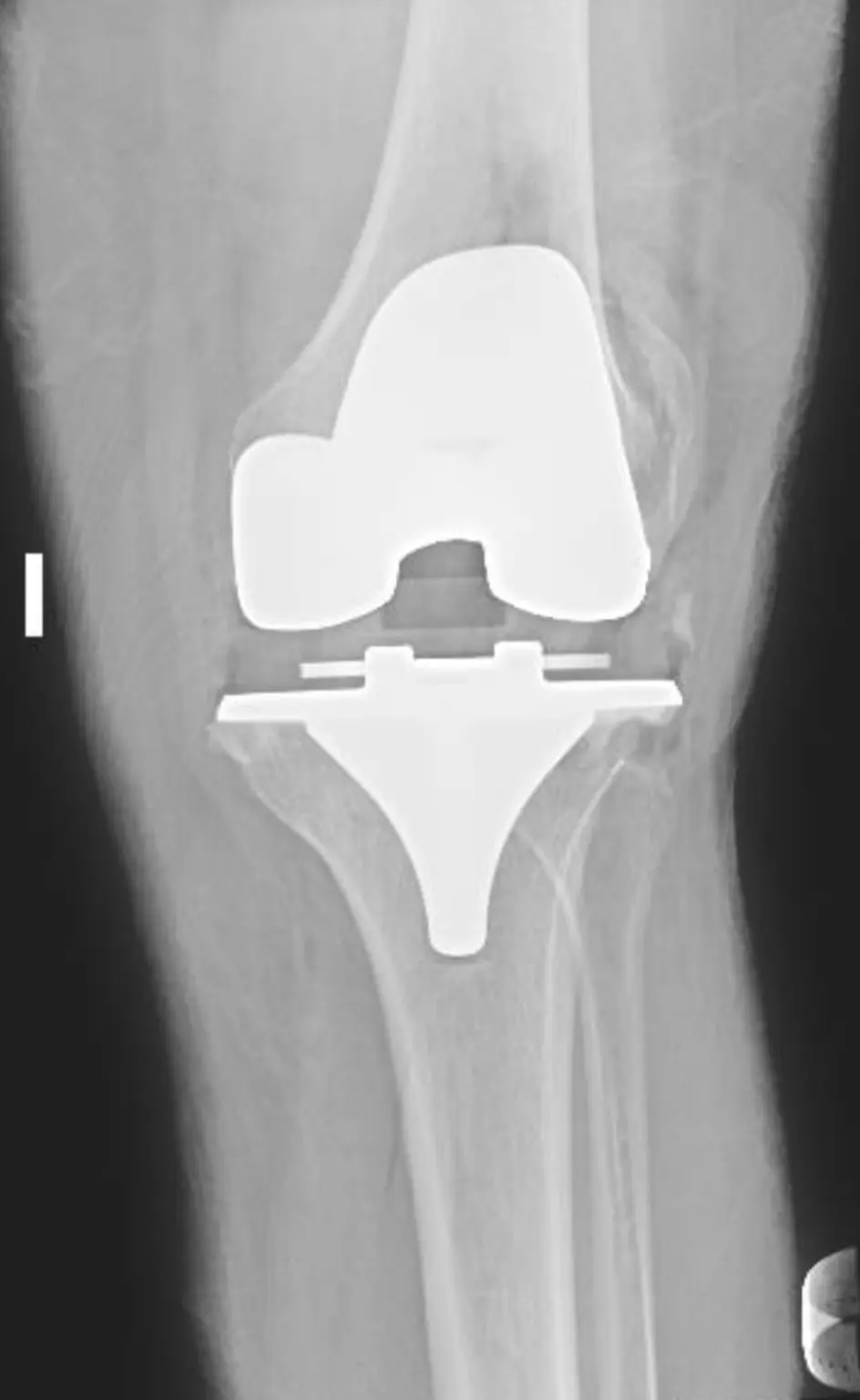 Radiografía frontal de una prótesis total de rodilla