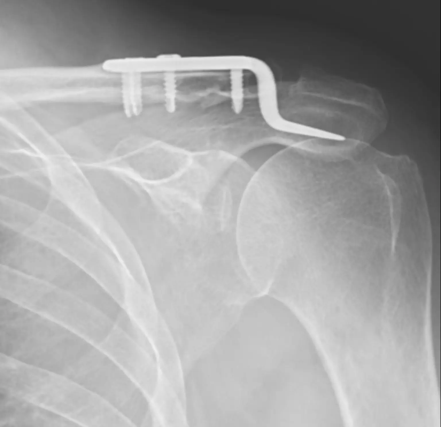 Radiografía posoperatoria de hombro con material de fijación