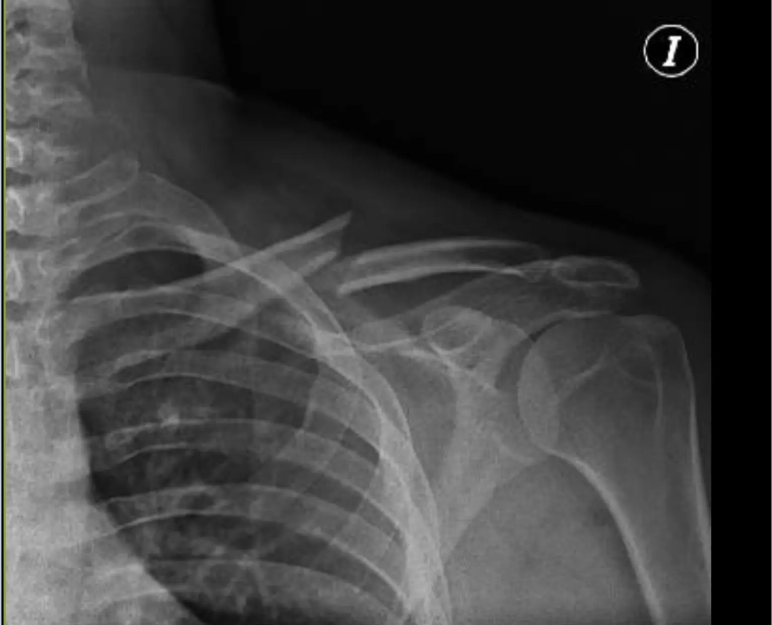Radiografía de una fractura desplazada de clavícula