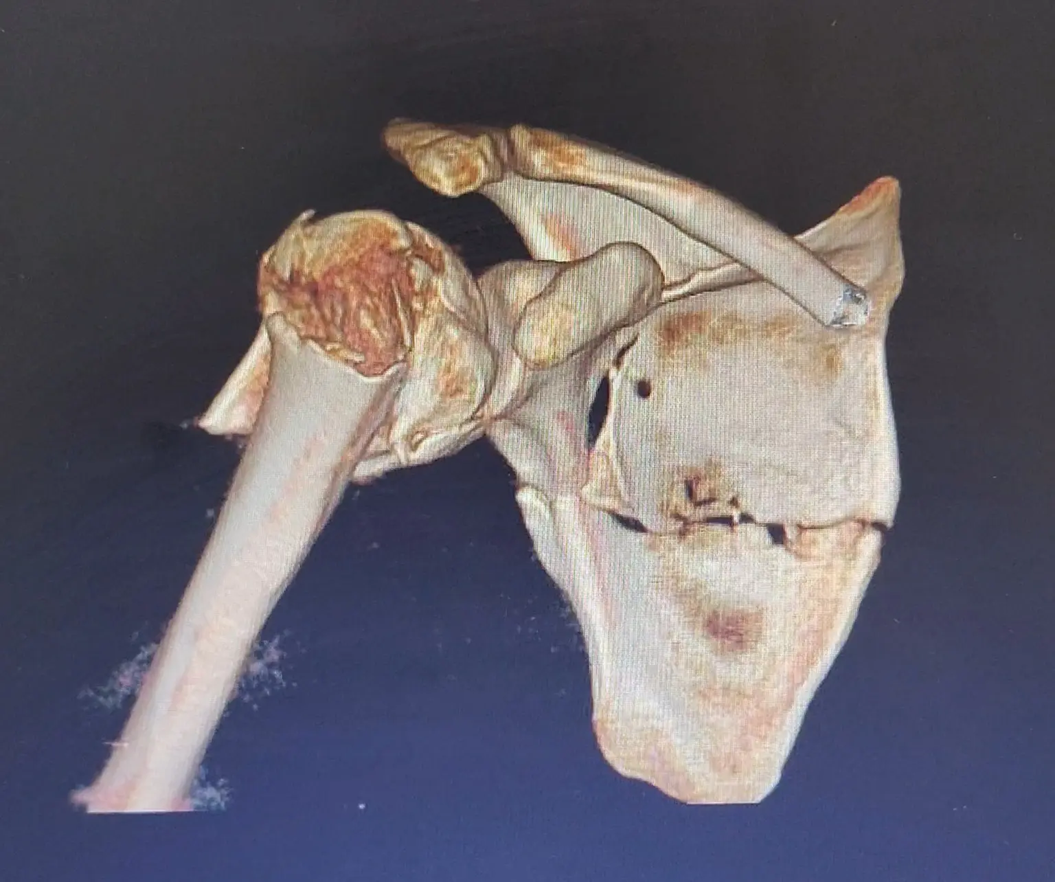 Reconstrucción tridimensional de una fractura de húmero proximal