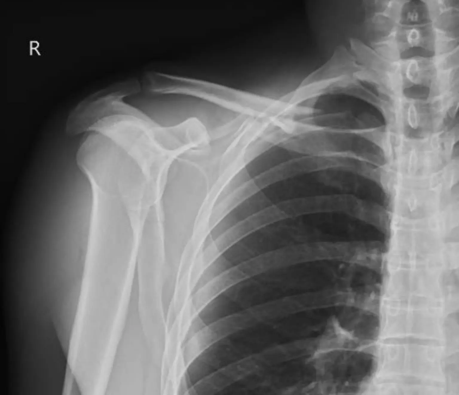Radiografía de hombro después de un traumatismo