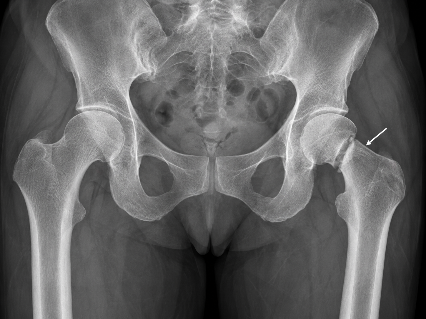 Radiografía AP de pelvis con fractura de cadera señalada