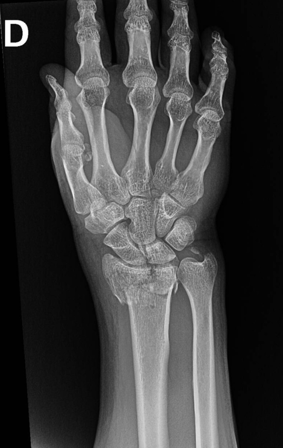 Radiografía AP educativa de fractura de radio distal