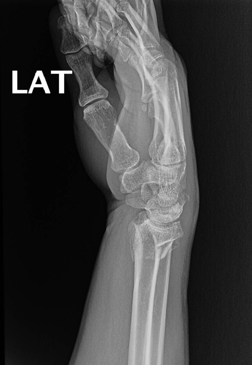Radiografía lateral educativa de fractura de radio distal