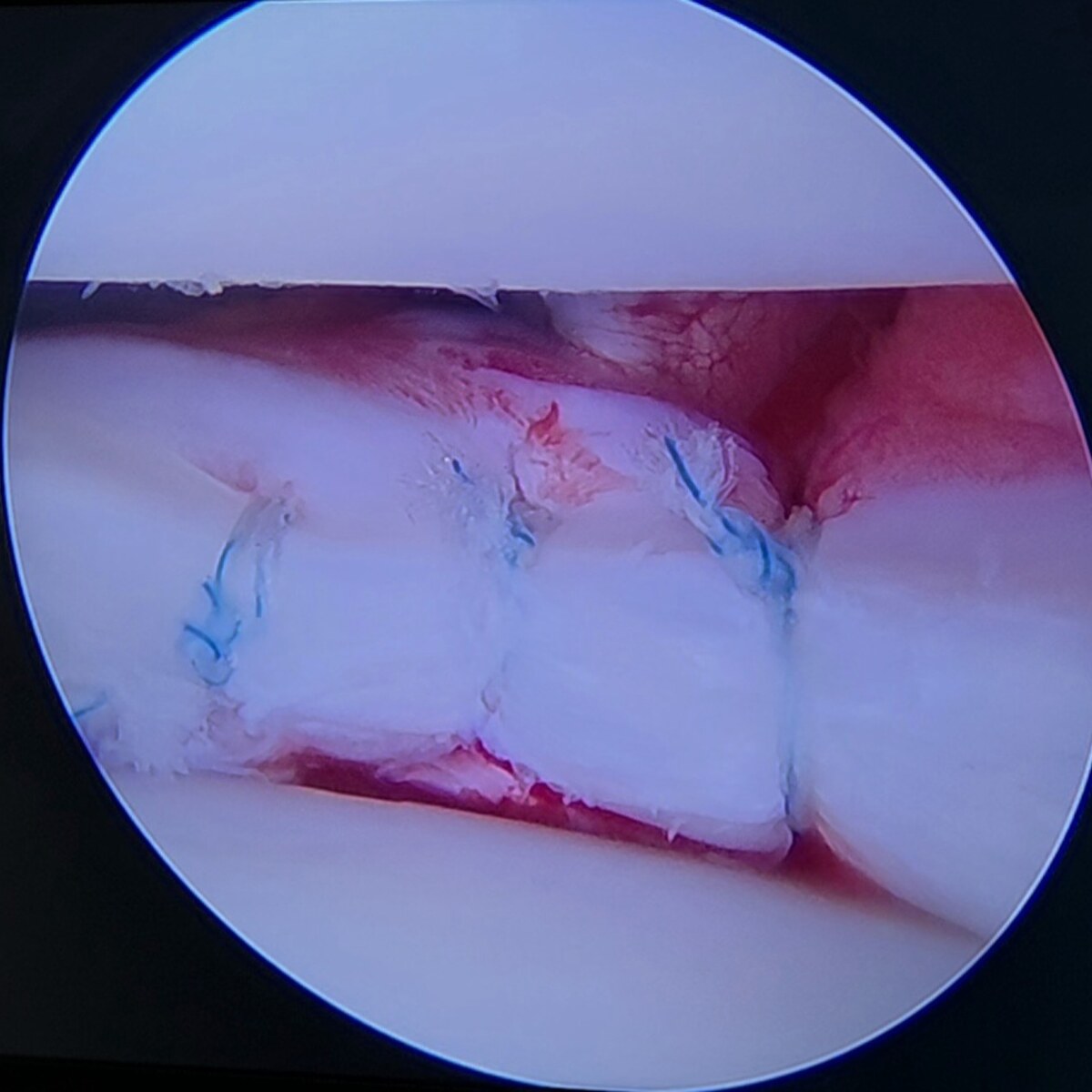 Artroscopia después de estabilizar el menisco lateral con suturas
