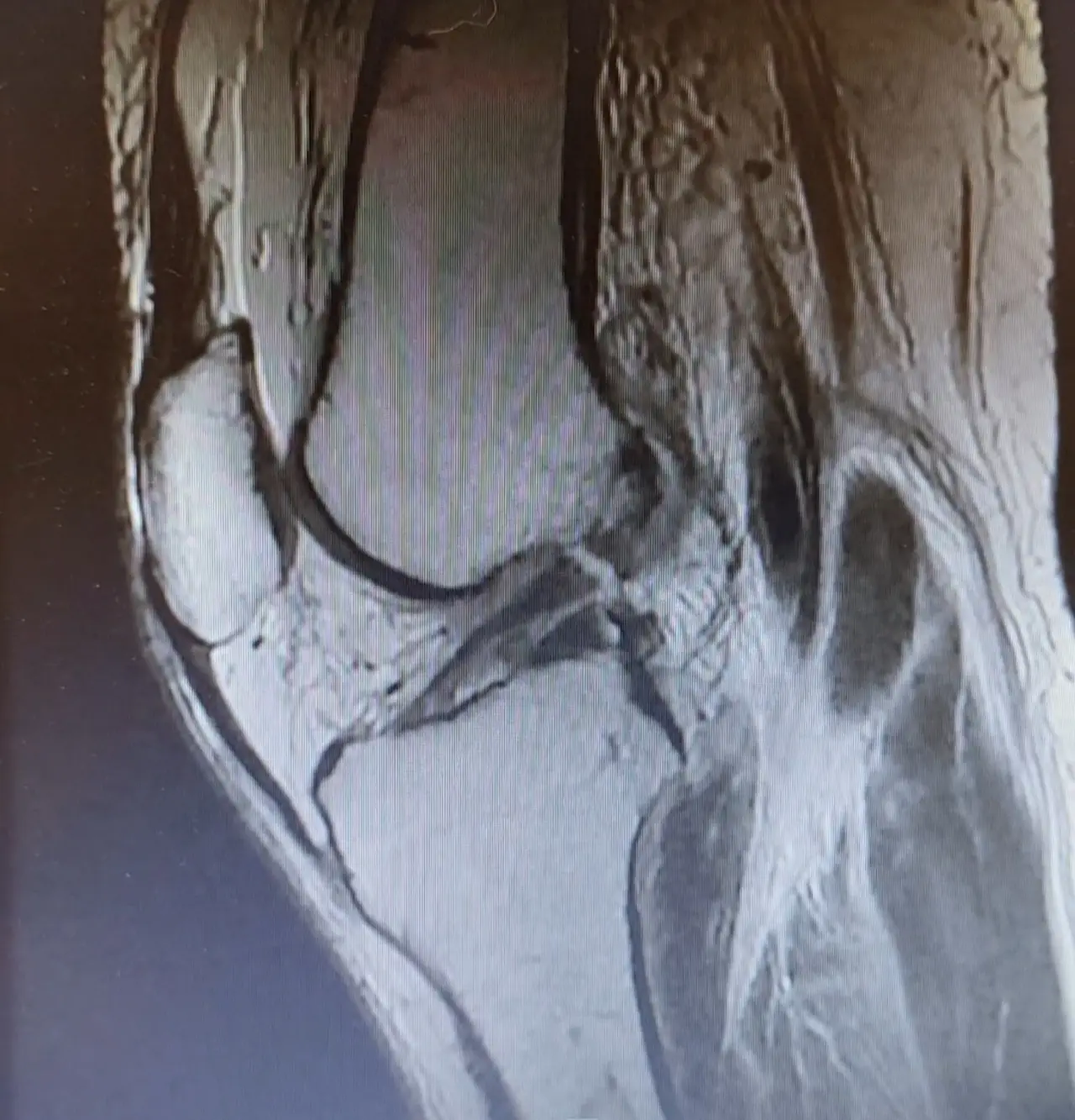 Resonancia de rodilla con lesión de ligamento cruzado anterior